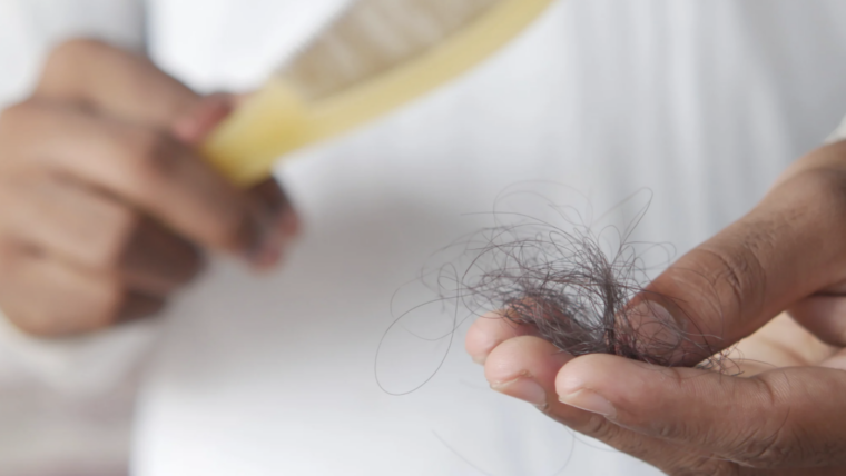 Best Black Dermatologist for Hair Loss Near Washington, DC